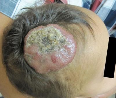 Female patient presenting with a large ulcerated IH pre-treatment