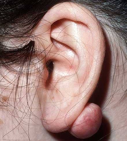A keloid on the posterior earlobe of a young female