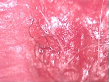 Image taken at 100x magnification of the patient's skin